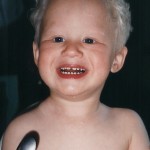 Juni 2000. Hugo är 1 år 9 månader. Det ser ut som EN knöl på höger sida vid halsen.  Röntgen visar TRE knölar. Några veckor senare är svullnaden borta. Men har lämnat efter sig ett litet FOP-ben vid nyckelbenet.