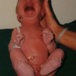 23 Sept 1998. Nyfödd. FOP tecken. Korta inåtböjda stortår.