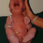 23 Sept 1998. Nyfödd. FOP tecken. Korta inåtböjda stortår.