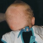 5 Mars 1999. 5½ månad gammal. Flare up på huvudet. Både platt & snett orsakad av svullnad/knöl på vänster sida.