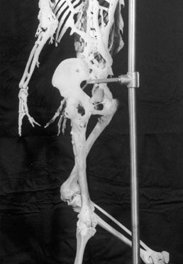 Harry Eastlack FOP-Skelett
