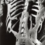 Skelett med FOP-ben. Harry Eastlack 1933-1973. Finns idag på The Mutter Museum i Philadelphia.