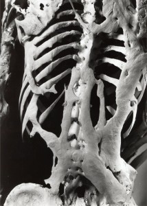 Skelett med FOP-ben. Harry Eastlack 1933-1973. Finns idag på The Mutter Museum i Philadelphia.